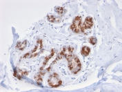 IHC staining of FFPE human breast carcinoma tissue with GSTM3 antibody (clone CPTC-GSTMu3-1). HIER: boil tissue sections in pH 9 10mM Tris with 1mM EDTA for 20 min and allow to cool before testing.