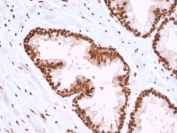 IHC testing of FFPE human prostate carcinoma with APE1 antibody (clone CPTC-APEX1-2). Required HIER: steam section in pH6 citrate buffer for 20 min and allow to cool prior to staining.