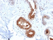 IHC testing of FFPE human breast carcinoma stained with recombinant Mammaglobin antibody (clone MGB/2123R). Required HIER: boiling tissue sections in 10mM citrate buffer, pH6, for 10-20 min followed by cooling at RT for 20 min.