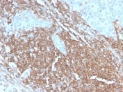 IHC staining of FFPE human lymph node with recombinant CD45RB antibody. HIER: boil tissue sections in pH6, 10mM citrate buffer, for 10-20 min followed by cooling at RT for 20 min.