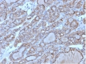IHC staining of FFPE human thyroid tissue with CD56 antibody (clone 56C04/123A8). HIER: boil tissue sections in pH9 EDTA buffer for 10-20 min followed by cooling at RT for 20 min.