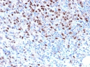 IHC staining of FFPE human melanoma with recombinant MITF antibody (clone MITF/2987R). HIER: boil tissue sections in pH 9 10mM Tris with 1mM EDTA for 10-20 min and allow to cool before testing.