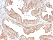 IHC staining of FFPE human prostate carcinoma with CD47 antibody (clone CD47/3019). HIER: boil tissue sections in pH 9 10mM Tris with 1mM EDTA for 10-20 min and allow to cool before testing.