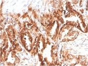 IHC staining of FFPE human prostate carcinoma with biotinylated CD47 antibody (clone CD47/2937). HIER: boil tissue sections in pH 9 10mM Tris with 1mM EDTA for 10-20 min and allow to cool before testing.