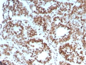 IHC staining of FFPE human colon carcinoma with MSH6 antibody (clone MSH6/3086). HIER: boil tissue sections in pH 9 10mM Tris with 1mM EDTA for 10-20 min and allow to cool before testing.