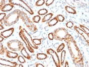 IHC staining of FFPE human renal cell carcinoma with CD137 antibody (clone 4-1BB/3201). HIER: boil tissue sections in pH9 10mM Tris with 1mM EDTA for 10-20 min and allow to cool before testing.