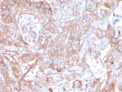 IHC staining of FFPE human colon carcinoma with CD73 antibody (clone NT5E/2505). HIER: boil tissue sections in pH9 10mM Tris with 1mM EDTA for 10-20 min and allow to cool before testing.