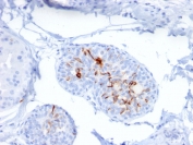 IHC staining of FFPE human breast carcinoma with ZNF690 antibody (clone ZSCAN29/2610). HIER: boil tissue sections in pH 9 10mM Tris with 1mM EDTA for 10-20 min and allow to cool before testing.