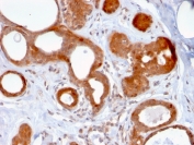 IHC staining of FFPE human breast carcinoma with ZNF690 antibody (clone ZSCAN29/2610). HIER: boil tissue sections in pH 9 10mM Tris with 1mM EDTA for 10-20 min and allow to cool before testing.