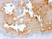 IHC staining of FFPE human prostate carcinoma with recombinant AMACR/p504S antibody (clone rAMACR/1864). HIER: boil tissue sections in pH 9 10mM Tris with 1mM EDTA for 10-20 min and allow to cool before testing.