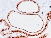 IHC testing of FFPE human prostate with FOXA1 antibody (clone FOXA1/1516). HIER: steam sections in pH 9 10mM Tris with 1mM EDTA for 10-20 min and allow to cool before testing.