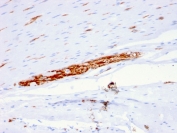 IHC staining of FFPE human colon with NCAM antibody (clone ERIC-1). HIER: boil tissue sections in pH 9 10mM Tris with 1mM EDTA for 20 min and allow to cool before testing.