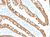 IHC staining of FFPE human colon carcinoma with Cytokeratin 20 antibody (clone SPM140). HIER: boil tissue sections in pH 9 10mM Tris with 1mM EDTA for 20 min and allow to cool before testing.