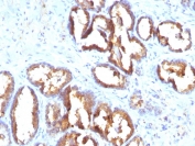 IHC staining of FFPE human prostate carcinoma with PSAP antibody (clone PASE/4LJ). HIER: boil tissue sections in pH 9 10mM Tris with 1mM EDTA for 20 min and allow to cool before testing.