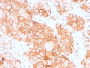IHC staining of FFPE human testicular carcinoma with recombinant Prolactin Receptor antibody (clone PRLR/3785R). HIER: boil tissue sections in pH 9 10mM Tris with 1mM EDTA for 20 min and allow to cool before testing.