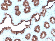 IHC staining of FFPE human breast carcinoma with recombinant pS2 antibody (clone rTFF1/1091). HIER: boil tissue sections in pH 9 10mM Tris with 1mM EDTA for 20 min and allow to cool before testing.