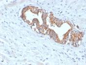 IHC testing of FFPE human prostate carcinoma with recombinant AMACR antibody (clone AMACR/4572R). Required HIER: steam section in pH 9 10mM Tris with 1mM EDTA for 20 min and allow to cool prior to staining.
