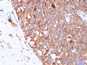 IHC staining of FFPE human urothelial carcinoma with UPK1B antibody (clone UPK1B/3102). HIER: boil tissue sections in pH 9 10mM Tris with 1mM EDTA for 20 min and allow to cool before testing.