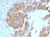 IHC staining of FFPE human urothelial carcinoma with UPK1B antibody (clone UPK1B/3102). HIER: boil tissue sections in pH 9 10mM Tris with 1mM EDTA for 20 min and allow to cool before testing.
