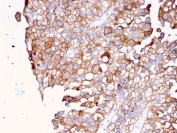 IHC staining of FFPE human urothelial carcinoma with UPK1B antibody (clone UPK1B/3081). HIER: boil tissue sections in pH 9 10mM Tris with 1mM EDTA for 20 min and allow to cool before testing.