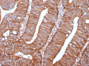 IHC staining of FFPE human colon carcinoma with Calpastatin antibody (clone CAST/1550). HIER: boil tissue sections in pH 9 10mM Tris with 1mM EDTA for 20 min and allow to cool before testing.