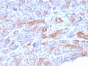 IHC staining of FFPE human pancreatic carcinoma with MRP3 antibody (clone ABCC3/2971). HIER: boil tissue sections in pH 9 10mM Tris with 1mM EDTA for 20 min and allow to cool before testing.
