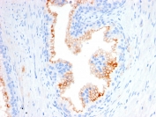 IHC staining of FFPE human prostate carcinoma with CD10 antibody (clone MME/2580). HIER: boil tissue sections in pH 9 10mM Tris with 1mM EDTA for 20 min and allow to cool before testing.