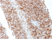 IHC staining of FFPE human melanoma with CD63 antibody (clone LAMP3/2881). HIER: boil tissue sections in pH 9 10mM Tris with 1mM EDTA for 20 min and allow to cool before testing.