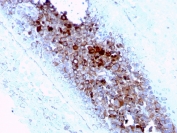 IHC staining of FFPE human melanoma with CD63 antibody (clone LAMP3/2789). HIER: boil tissue sections in pH 9 10mM Tris with 1mM EDTA for 20 min and allow to cool before testing.