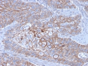 IHC staining of FFPE human breast carcinoma with E-Cadherin antibody (clone CDH1/3256). HIER: boil tissue sections in pH 9 10mM Tris with 1mM EDTA for 20 min and allow to cool before testing.