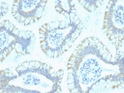 IHC staining of FFPE human colon carcinoma with SMAD4 antibody (clone SPM448). HIER: boil tissue sections in pH 9 10mM Tris with 1mM EDTA for 20 min and allow to cool before testing.