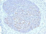 IHC staining of FFPE human cervix with HPV16 E1/E4 antibody. HIER: boil tissue sections in pH 9 10mM Tris with 1mM EDTA for 20 min and allow to cool before testing.