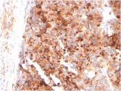 IHC staining of FFPE human melanoma with CD63 antibody (clone LAMP3/3315). HIER: boil tissue sections in pH 9 10mM Tris with 1mM EDTA for 20 min and allow to cool before testing.