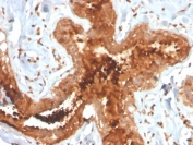 IHC staining of FFPE human breast carcinoma with recombinant Mammaglobin antibody (clone MGB/4058R). HIER: boil tissue sections in pH 9 10mM Tris with 1mM EDTA for 20 min and allow to cool before testing.