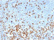 IHC staining of FFPE human lymphoma with recombinant ZAP70 antibody. HIER: boil tissue sections in pH 9 10mM Tris with 1mM EDTA for 20 min and allow to cool before testing.