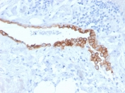 IHC staining of FFPE human lung mesothelioma with Mesothelin antibody (clone MSLN/3384). HIER: boil tissue sections in pH 9 10mM Tris with 1mM EDTA for 20 min and allow to cool before testing.