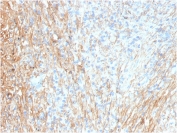 IHC staining of FFPE human lung with Fibronectin antibody (clone FN1/3036). HIER: boil tissue sections in pH 9 10mM Tris with 1mM EDTA for 20 min and allow to cool before testing.