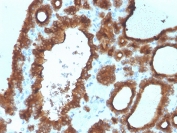 IHC staining of FFPE human thyroid carcinoma with Thyroid Peroxidase antibody. HIER: boil tissue sections in pH 9 10mM Tris with 1mM EDTA for 20 min and allow to cool before testing.