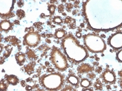 IHC staining of FFPE human thyroid carcinoma with TPO antibody. HIER: boil tissue sections in pH 9 10mM Tris with 1mM EDTA for 20 min and allow to cool before testing.