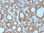 IHC staining of FFPE human thyroid carcinoma with TPO antibody. HIER: boil tissue sections in pH 9 10mM Tris with 1mM EDTA for 20 min and allow to cool before testing.