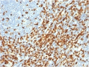 IHC staining of FFPE human lymphoma with recombinant ZAP70 antibody. HIER: boil tissue sections in pH 9 10mM Tris with 1mM EDTA for 20 min and allow to cool before testing.