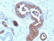 HC staining of FFPE human breast carcinoma with Mammaglobin antibody (clone MGB/4056). HIER: boil tissue sections in pH 9 10mM Tris with 1mM EDTA for 20 min and allow to cool before testing.