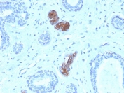 HC staining of FFPE human breast carcinoma with Mammaglobin antibody (clone MGB/4056). HIER: boil tissue sections in pH 9 10mM Tris with 1mM EDTA for 20 min and allow to cool before testing.