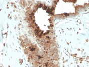 IHC staining of FFPE human breast carcinoma with recombinant Mammaglobin antibody (clone MGB/4057R). HIER: boil tissue sections in pH 9 10mM Tris with 1mM EDTA for 20 min and allow to cool before testing.
