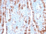 IHC staining of FFPE human thyroid carcinoma with TPO antibody. HIER: boil tissue sections in pH 9 10mM Tris with 1mM EDTA for 20 min and allow to cool before testing.