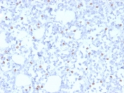 IHC staining of FFPE human breast carcinoma with Estrogen Receptor beta 1 antibody (clone PPG5/10). HIER: boil tissue sections in pH 9 10mM Tris with 1mM EDTA for 20 min and allow to cool before testing.