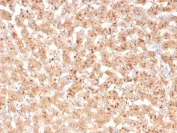 IHC staining of FFPE human liver with TTR antibody. HIER: boil tissue sections in pH 9 10mM Tris with 1mM EDTA for 20 min and allow to cool before testing.