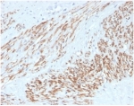 IHC staining of FFPE human leiomyosarcoma tissue with recombinant MYH11 antibody (clone MYH11/4337R). HIER: boil tissue sections in pH 9 10mM Tris with 1mM EDTA for 20 min and allow to cool before testing.