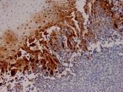 IHC staining of FFPE human esophageal carcinoma tissue with recombinant HSV1 antibody (clone HSV1/4055R). HIER: boil tissue sections in pH 9 10mM Tris with 1mM EDTA for 20 min and allow to cool before testing.