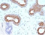 IHC staining of FFPE human breast carcinoma tissue with recombinant BAP1 antibody (clone BAP1/6861R). Negative control inset: PBS instead of primary antibody to control for secondary binding. HIER: boil tissue sections in pH 9 10mM Tris with 1mM EDTA for 20 min and allow to cool before testing.